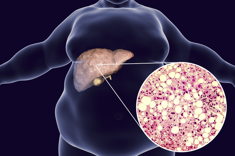 How does obesity lead to fatty liver disease?