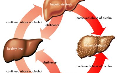 What is meant by alcoholic hepatitis?