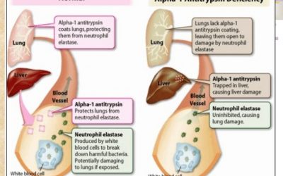 What is the most common cause of cirrhosis in childhood