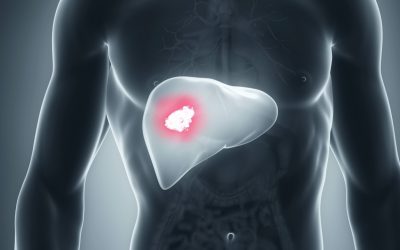 Liver Cancer – Avoid this lifestyle that increases cancer risk