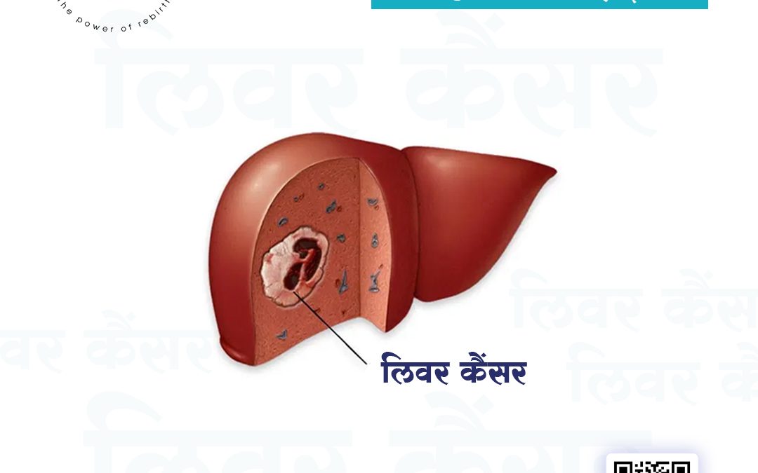 यकृत कर्करोग – कारणे व लक्षणे