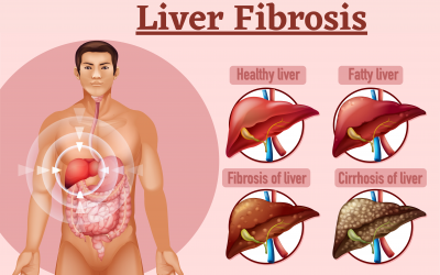 Fibrosis of the Liver