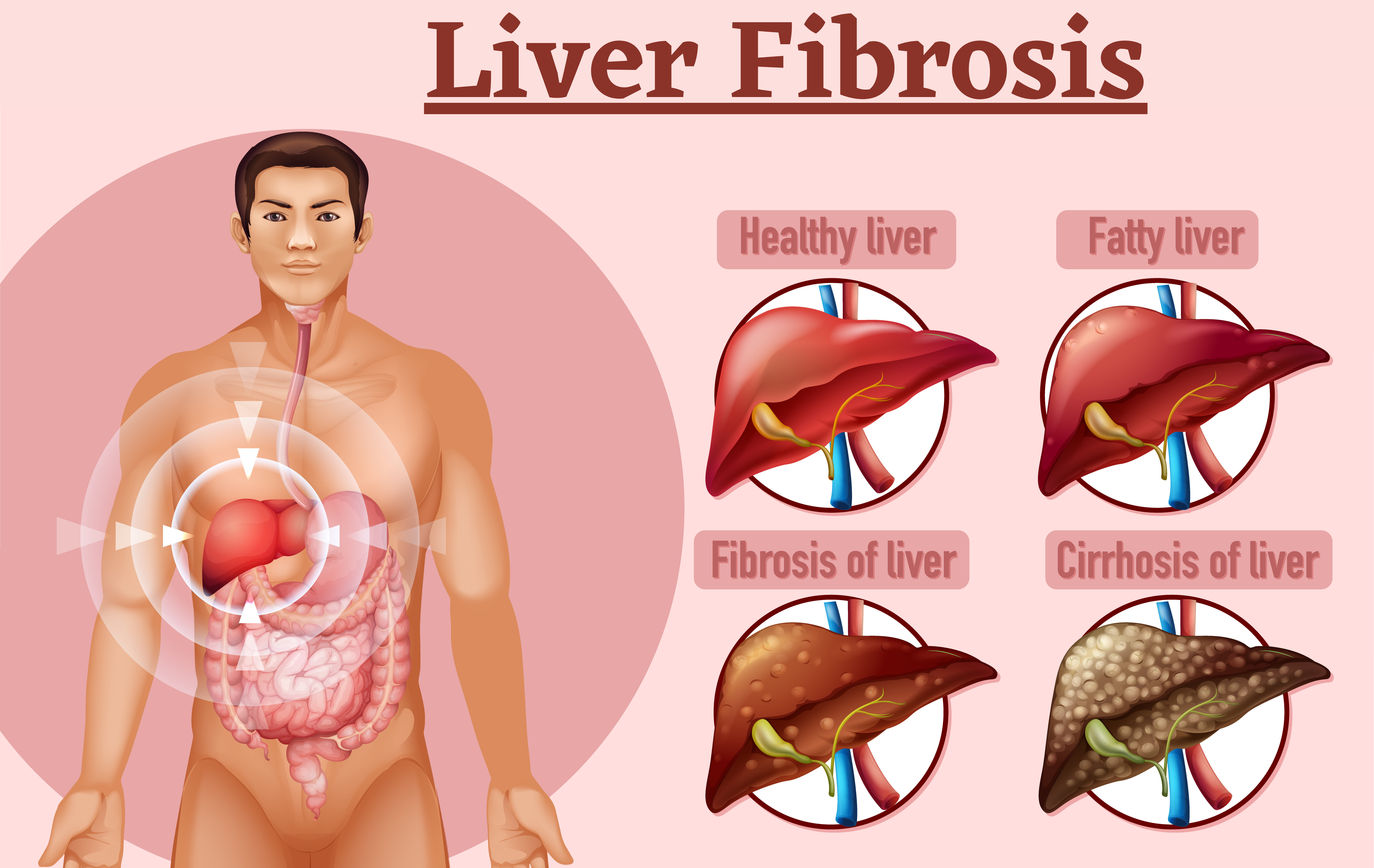 Liver fibrosis: Stages, symptoms, and treatment