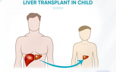 Liver Transplant for Children