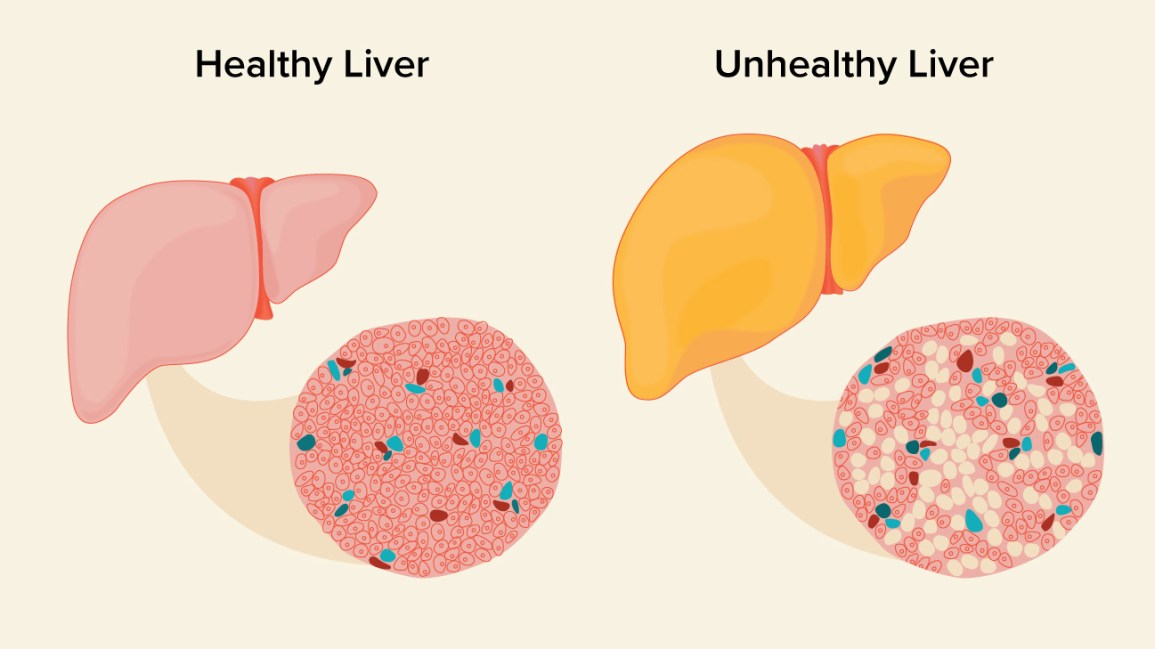 Fatty liver diet