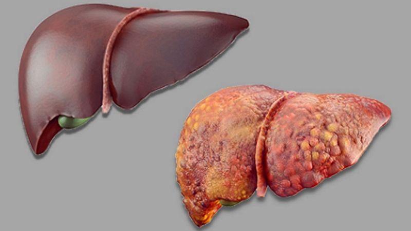 Liver Failure - Symptoms, Causes, Diagnosis, Test, Treatments & More