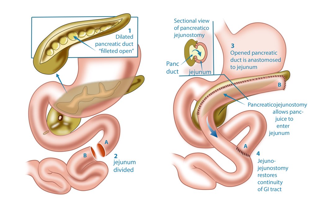 BRON surgery for chronic pancreatitis perth