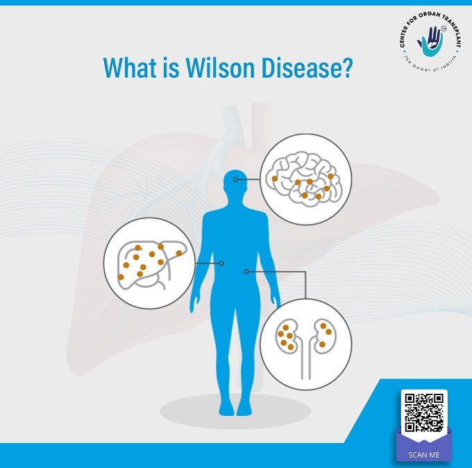 What is Wilson Disease?