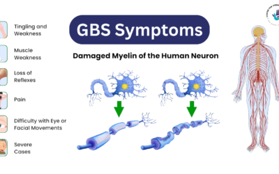 Guillain-Barré syndrome surge in Pune: What’s Behind the Rising Cases?