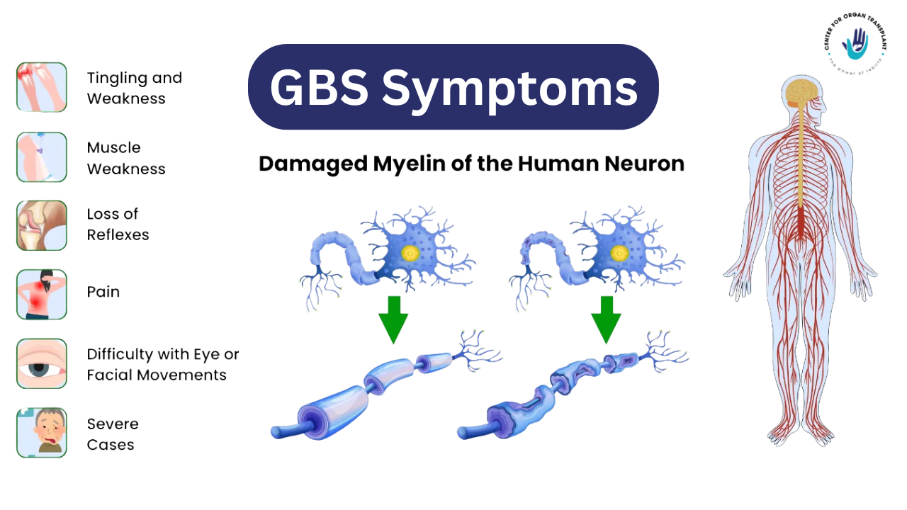 Guillain-Barré syndrome surge in Pune: What’s Behind the Rising Cases?