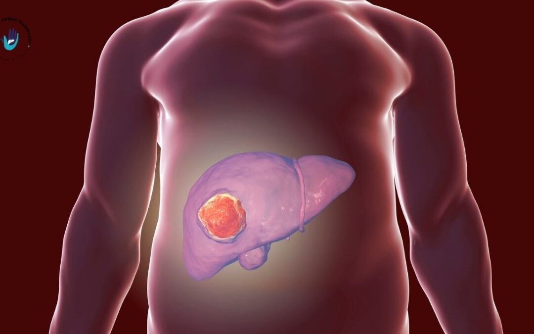 Liver Cancer: Understanding the Silent Threat and How Early Diagnosis Makes All the Difference