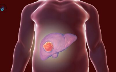 Liver Cancer: Understanding the Silent Threat and How Early Diagnosis Makes All the Difference