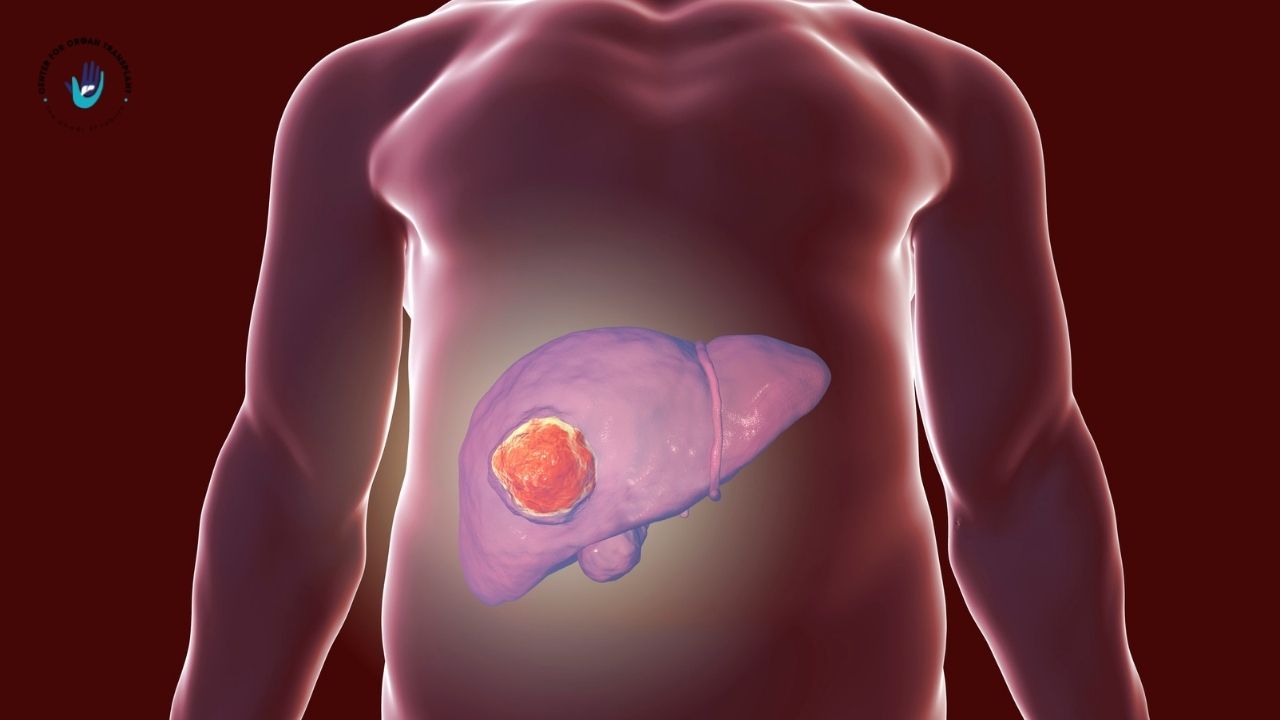 Illustration of a human liver showing cancerous tumours, highlighting early detection and treatment importance.