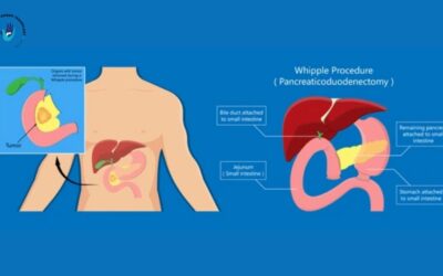 Pancreatic Cancer Treatment in Pune – यकृत आणि अग्न्याशय–उपचाराची संपूर्ण माहिती