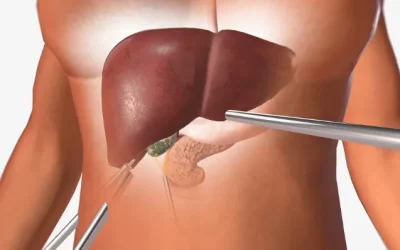Liver Biopsy for NASH — What It Involves and Whether You Actually Need One