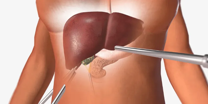 What Does a Liver Biopsy for NASH Actually Involve — Is It the Only Way to Confirm the Diagnosis What Does a Liver Biopsy for NASH Actually Involve — Is It the Only Way to Confirm the Diagnosis