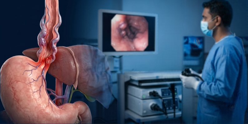 Esophageal Varices Bleeding_ Treatment and When a Transplant Is Needed